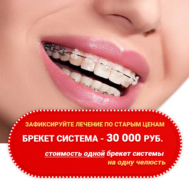 Брекет система