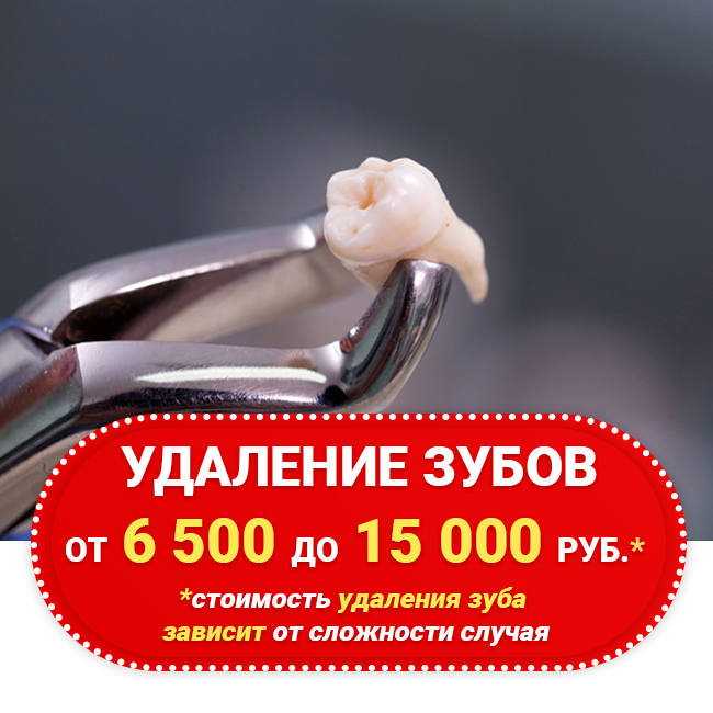 Удаление зуба