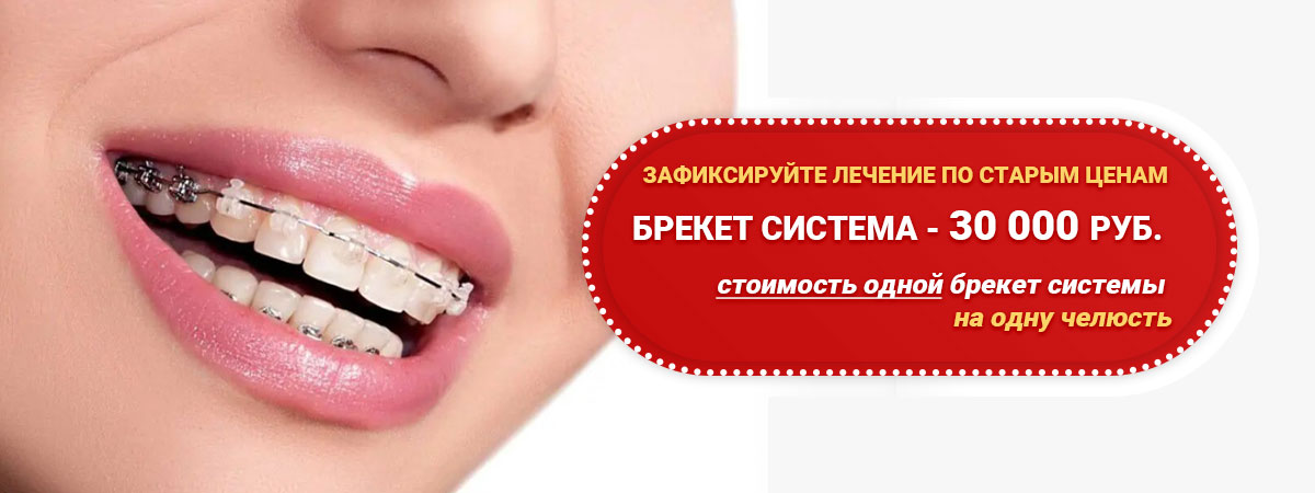 Брекет система